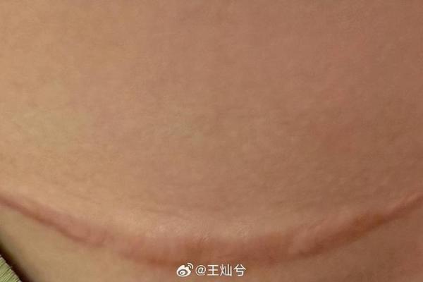 7年5次剖腹产 第四次剖腹产不必害怕